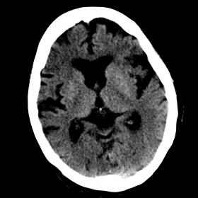 Axial NE-CT showed some little ischemic injuries in basal ganglia regions.