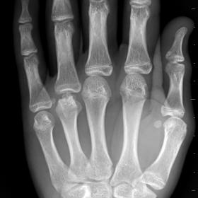 Posteroanterior (A) and oblique (B) hand radiography depicting an abnormality in the morphology of the distal end of the 4th 