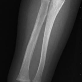 Anteroposterior radiographs of the right (A) and left (B) forearms demonstrate a single lamellar periosteal reaction in the r