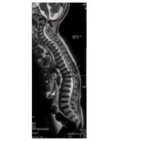 T2-weighted whole spine sagittal image shows hypoplastic dens (blue arrow), hypointense soft tissue thickening around dens (y