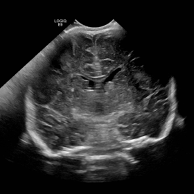 Coronal ultrasound brain at level of foramen of Monro shows subependymal nodules along the lateral ventricular walls of mixed