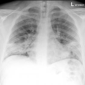 The initial AP CXR shows patchy, bilateral consolidation in a lower zone distribution.