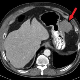 Abdominal CT scan with contrast:  5 cm solid lesion (red arrow) adjacent to the stomach in the left upper quadrant.