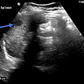 Hypoechoic rounded lesion measuring just over 1cm within the spleen (solid blue arrow). There is no associated splenomegaly.