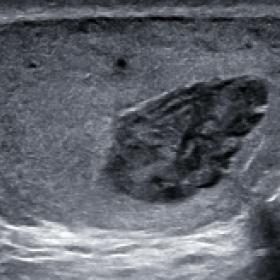 B-mode imaging demonstrates a heterogenous mass in the upper pole of the left testis.