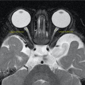 Hypoplastic optic nerves and chiasm. (a) Axial T2-weighted MR image shows hypoplastic optic nerves, each measuring approximat
