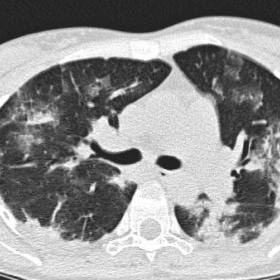 On chest CT at the first examination we can see multiple bilateral ground-glass opacities