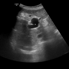 Ultrasound near the portal vein bifurcation depicts an outpouching consistent with an aneurysmatic sac measuring approximatel