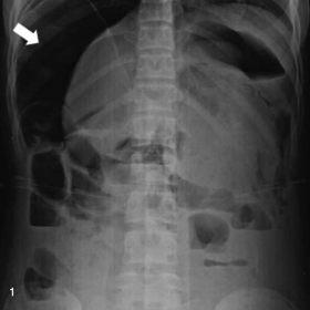 Plain abdominal radiography showing an important pneumoperitoneum (Arrow)