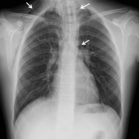 Posteroanterior chest radiography at the initial presentation shows air along the mediastinum and subcutaneous tissues.