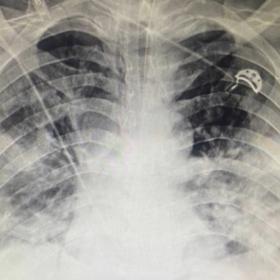 Chest x-ray AP view.(Left) Patient with covid-19 demonstrates bilateral middle and lower zone airspace opacities with areas c