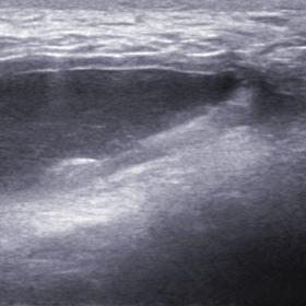USG of right thigh showing a well-defined thick walled anechoic lesion in the subcutaneous plane