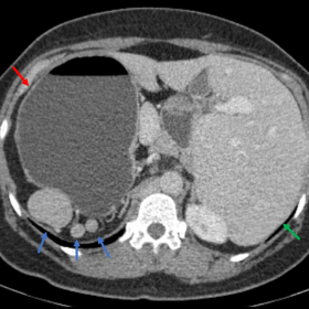 CT with axial contrast (portal phase) at the level of T12 showing polysplenia (blue arrows), the stomach on the right (red ar