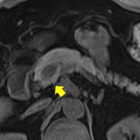 The portal vein is encircled by a bridge of a pancreatic bridge, normal in signal, connecting the head and the body of the pa