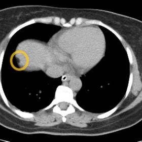 lain axial CT section of abdomen showing a well-defined fat density lesion( yellow circle) in subcapsular location involving 