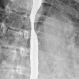Long-narrowed segment of the thoracic oesophagus with contrast stasis proximally.