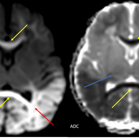 On MRI, symmetric areas of restricted diffusion are seen in bilateral parieto-occipital lobes in grey and white matter (red a