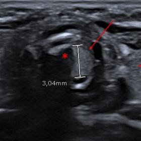 Axial US shows a well-defined homogeneous hyperechoic mass (arrow) which causes severe stenosis of airway (*). It can be seen