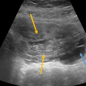 USG examination of small bowel with curvilinear probe placed in hypogastrium showed concentric wall thickening (yellow arrows