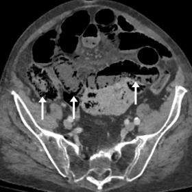 Axial image of contrast-enhanced abdominal CT scan of a 84-year-old man shows multiple locations of intramural bowel air in s