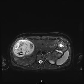 MRI – Fat-Saturated T2WI– dominant well-circumscribed right lobe liver mass, heterogeneous in nature, showing diffuse hyp