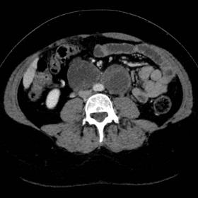 Contrast-enhanced CT, axial view