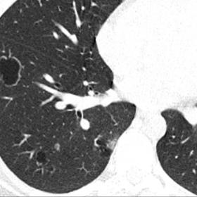 Chest CT images in lung parenchymal window, showing multiple cavitated nodules in the right lower lobe. The nodules show thin