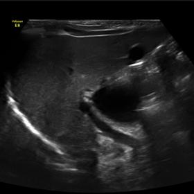 7th day of life ultrasound - thin-walled, anechoic cystic lesion located anteriorly to the portal vein, in the porta hepatis.