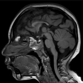 Sagittal T1WI showing microcephaly