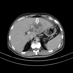axial contrast CT image showing an ill defined non enhancing hypodense collection in the left lobe of liver (abscess) with pe
