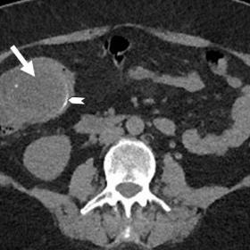 Axial CT-scan shows an oval-shaped hypodense lesion (white arrow) with discrete punctiform and peripheral calcifications (arr
