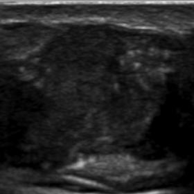 transverse ultrasound. Ultrasound with colour doppler, reveals a well delineated and lobulated, heterogeneously hypoechoic su