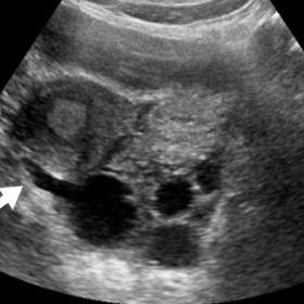 (A, B): Axial sonographic images, midline cystic mass (white arrow) is seen with gray-scale sonography lying deep to the uter