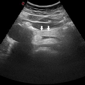 The ultrasound examination of the abdomen demonstrates the presence of hyperechoic pancreas (arrows)