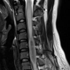 Sagittal T2W image shows a central, well-defined, elongated intramedullary lesion causing spinal cord expansion extending fro