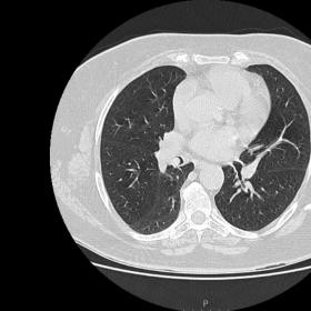 Axial chest CT image showed an endoluminal round image in the right lower bronchus; along with the clinical history, this sug