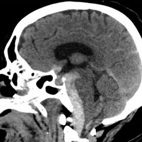 Sagittal non-contrast CT image revealing subarachnoid hemorrhage in the basal cisterns, causing obstructive hydrocephalus