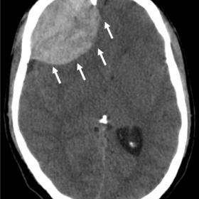 Axial CT without contrast showing hyperdense biconvex extradural mass, corresponding to acute epidural hematoma