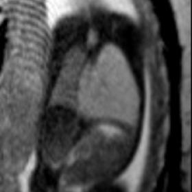 Coronal T2-weighted sequence image shows hyperintense mass in the left hemithorax