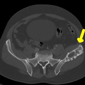 Axial (a) and coronal (b) computed tomography image showing a lenticular bone lesion, with hypodense center and smooth sclero