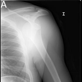AP (A) and scapulary (B) views of the left shoulder performed during episode of acute dislocation. Anterior displacement of t