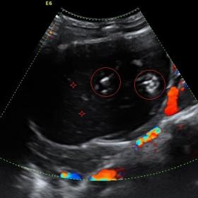 Abdominal sonogram showing renal hydatid cyst with floating parasitic membranes (circle) and falling snowflakes sign (asterix