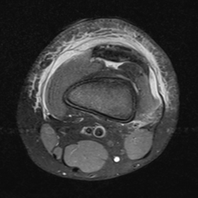 Axial PD-weighted fat-saturated images of the left knee immediately after the injury shows extensive subcutaneous edema aroun
