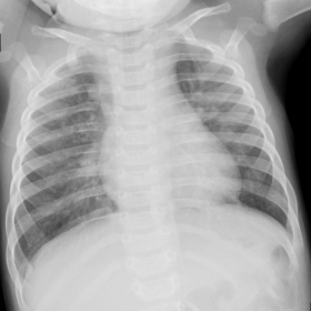AP chest x-ray obtained at the admission, 5 days after the onset of symptoms. Bilateral diffuse infiltrative opacification, w