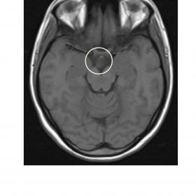 T1W axial image of MRI brain showing a suprasellar mass. It is isointense to grey matter
