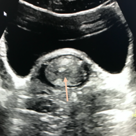 Transverse plane transabdominal ultrasound showing a homogeneous and isoechoic rounded structure in the vaginal lumen (arrow)