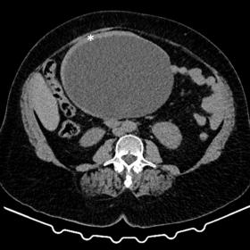 CT scan on axial plane pre- (a) and post-contrast administration (b) showing an unilocular cystic tumour with spontaneous hyp