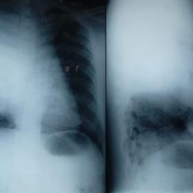 X ray frontal and lateral projection showing opacity in the right hemithorax, more towards the posterior aspect with shift of