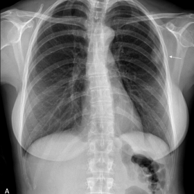 A. Chest X-ray showing a peripheral mass in the upper left hemithorax