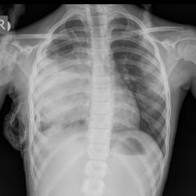 image demonstrating a large heterogeneous soft tissue density mass lesion involving right hemithorax silhouetting the right c
